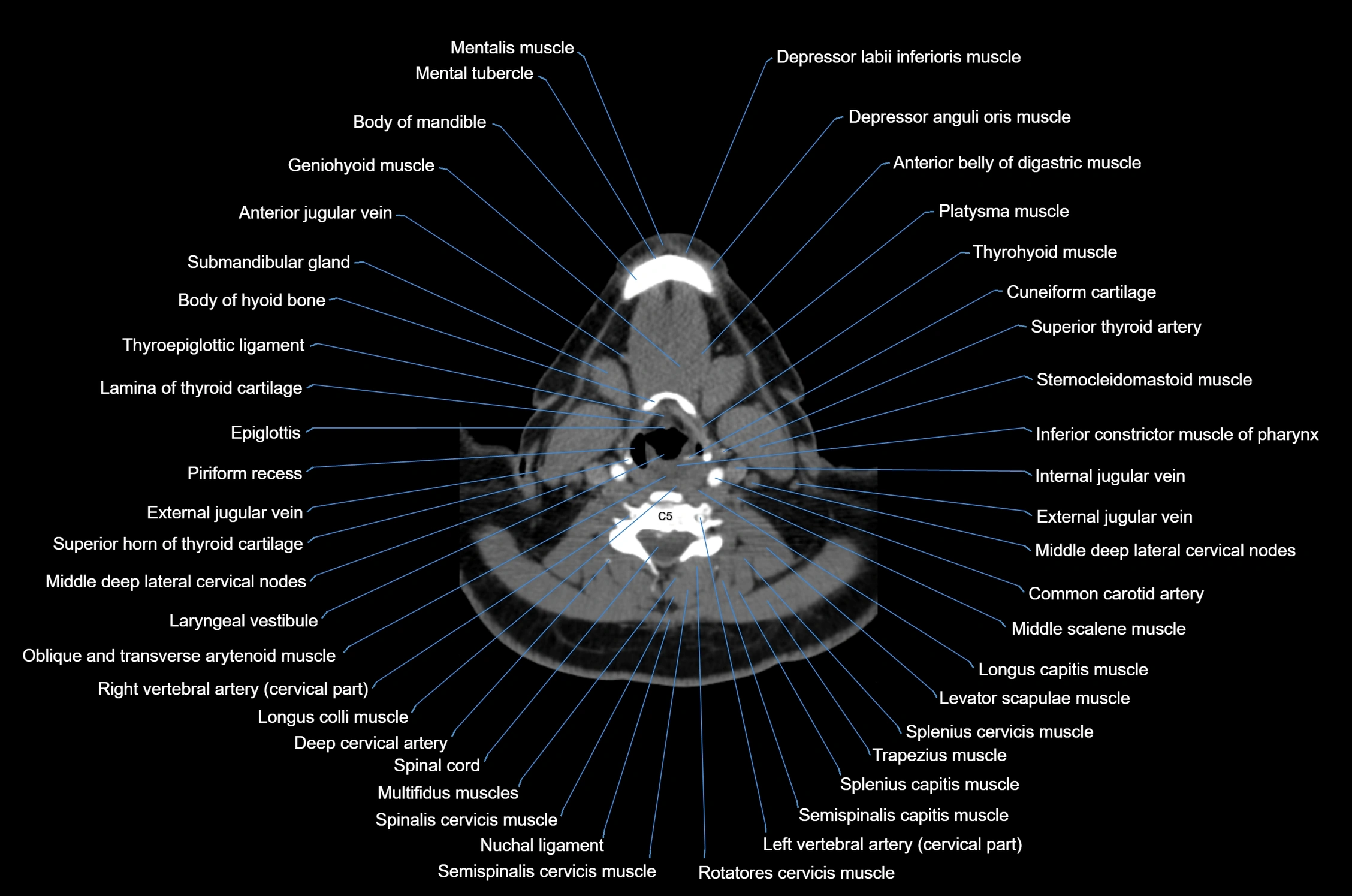 CT Neck axial cross sectional anatomy radiology image-img-00001-00040.webp